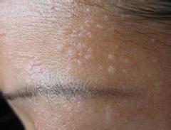 扁平疣的传染途径有哪些