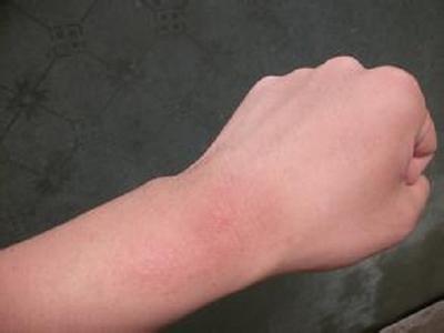 花粉过敏有什么症状